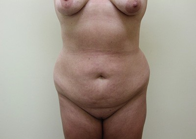 Before Image: Liposuction - front