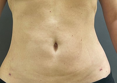 After Image: Liposuction - front