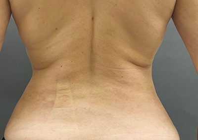 After Image: Liposuction - back