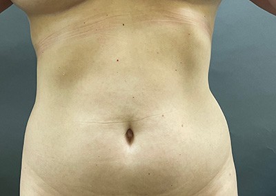 Before Image: Liposuction - front