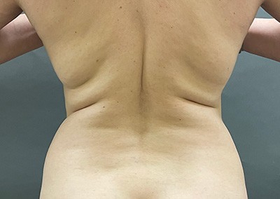 Before Image: Liposuction - back