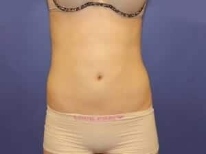 After Image: Liposuction - front