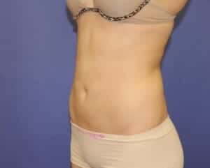 After Image: Liposuction - left-front-oblique