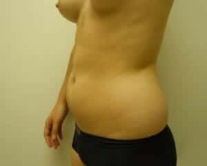 Before Image: Liposuction - left-front-oblique