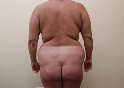 Before Image: Liposuction - back