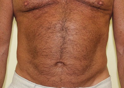 After Image: Liposuction - front