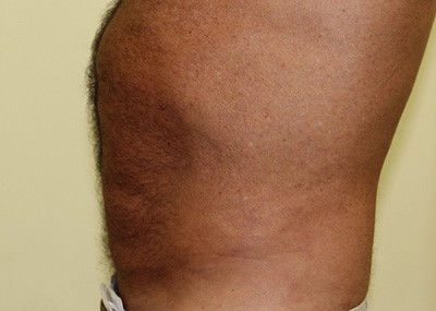 After Image: Liposuction - left-side