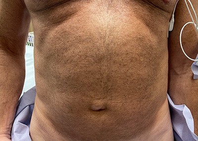 Before Image: Liposuction - front