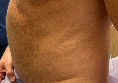 Before Image: Liposuction - left-side