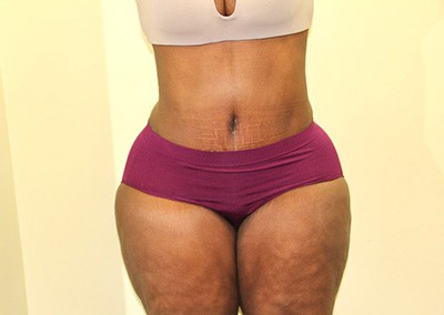 After Image: Liposuction - front