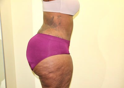 After Image: Liposuction - right-side