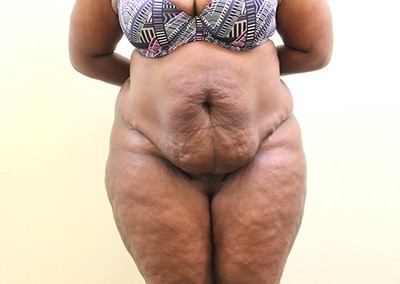 Before Image: Liposuction - front