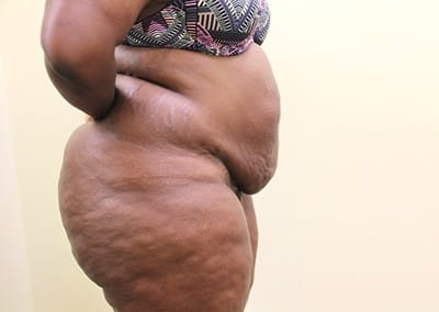Before Image: Liposuction - right-side