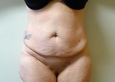 Before Image: Liposuction - front