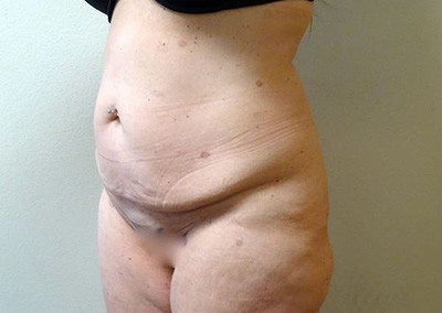 Before Image: Liposuction - left-front-oblique
