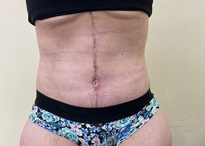 After Image: Liposuction - front