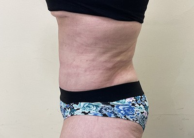 After Image: Liposuction - left-side