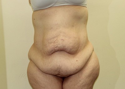 Before Image: Liposuction - front