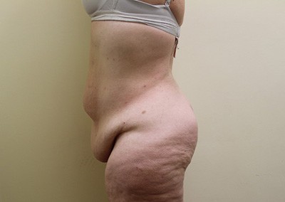 Before Image: Liposuction - left-side