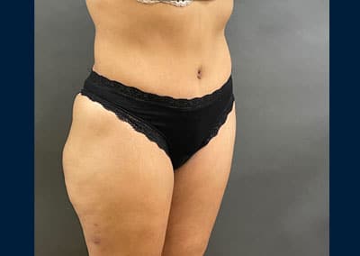 After Image: Liposuction - right-front-oblique