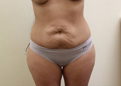 Before Image: Liposuction - front