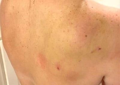 After Image: Liposuction - front
