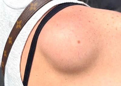Before Image: Liposuction - front