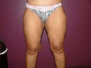 After Image: Liposuction - front
