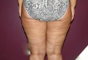 After Image: Liposuction - back