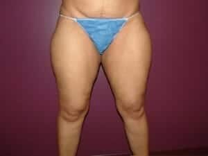 Before Image: Liposuction - front