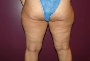 Before Image: Liposuction - back