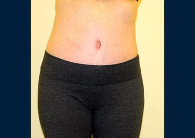 After Image: Liposuction - front