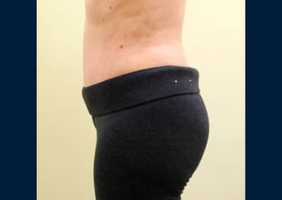 After Image: Liposuction - left-side