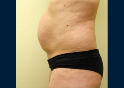 Before Image: Liposuction - left-side
