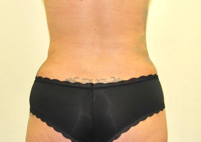 After Image: Liposuction - front