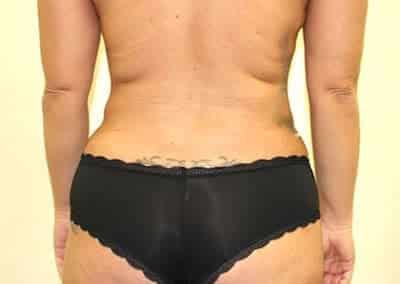Before Image: Liposuction - front