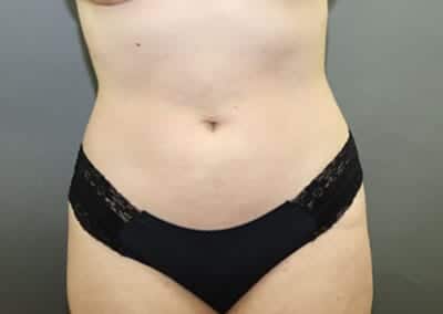 After Image: Liposuction - front