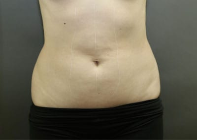 Before Image: Liposuction - front