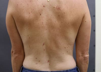 After Image: Liposuction - front