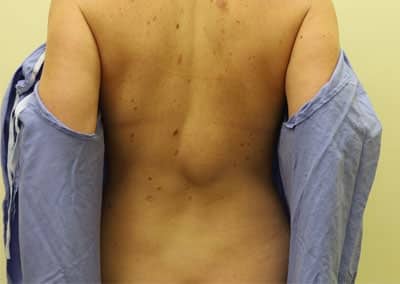 Before Image: Liposuction - front