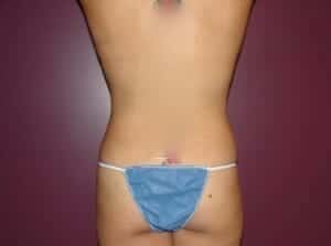 After Image: Liposuction - front