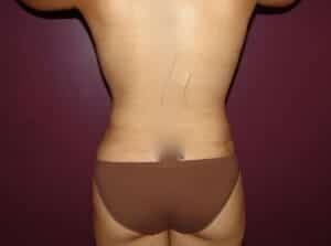 Before Image: Liposuction - front