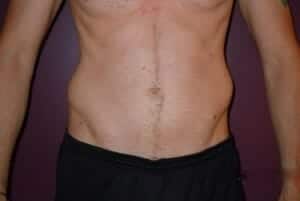 Before Image: Liposuction - front