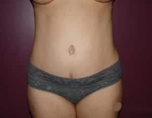 After Image: Liposuction - front