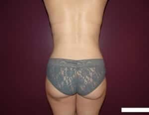 After Image: Liposuction - back
