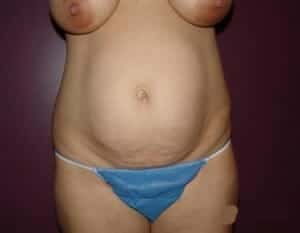 Before Image: Liposuction - front
