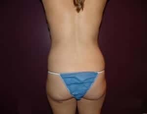 Before Image: Liposuction - back