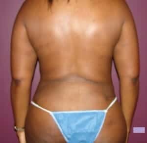 After Image: Liposuction - back
