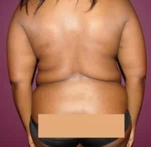Before Image: Liposuction - back