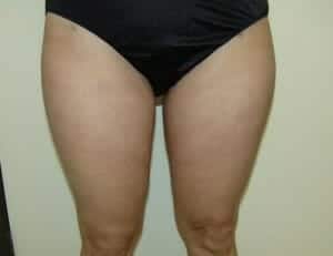 After Image: Liposuction - front